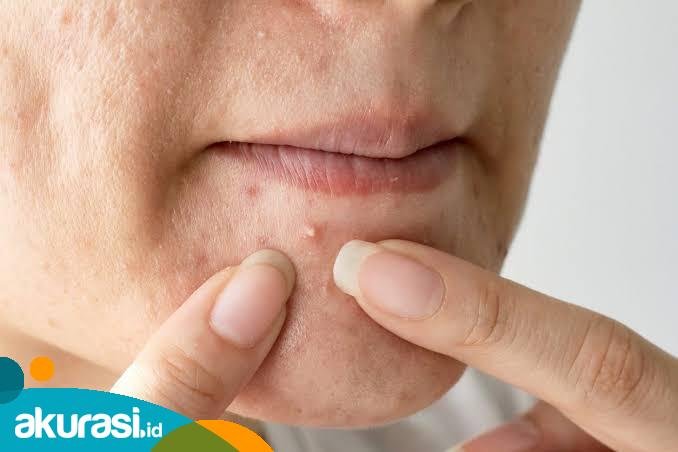 Memencet Jerawat Malah Bikin Semakin Parah, Ini Kata Dokter