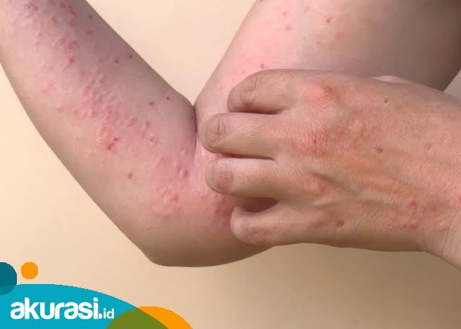 Waspada Penyebaran Wabah Cacar Monyet di Kaltim