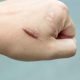 Keloid